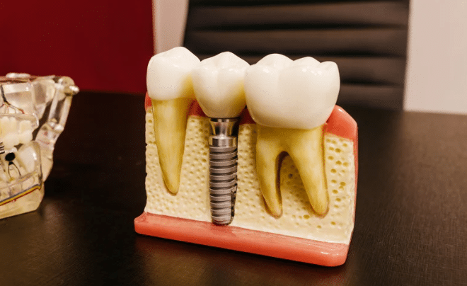 prótesis fija sobre implantes